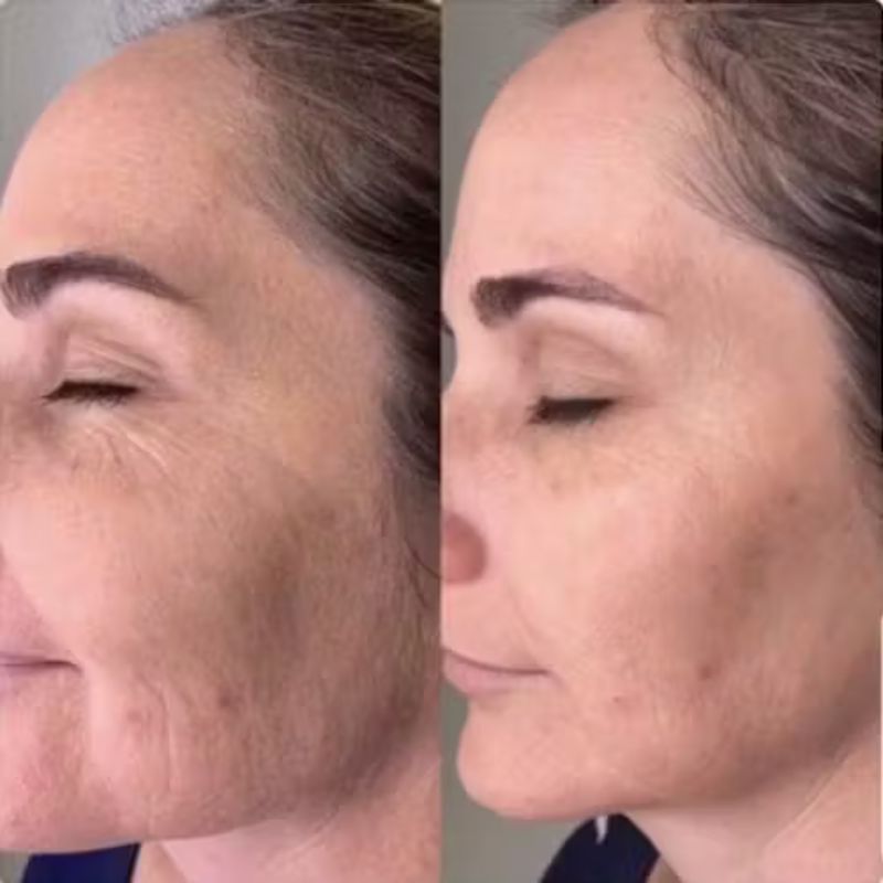 Dispositivo Hexibella MicroGlow