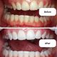 Set NanoSmile