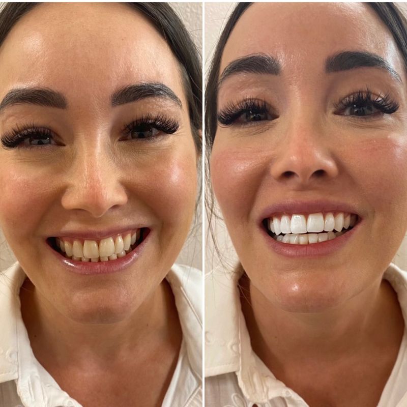 Set NanoSmile