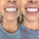 Set NanoSmile