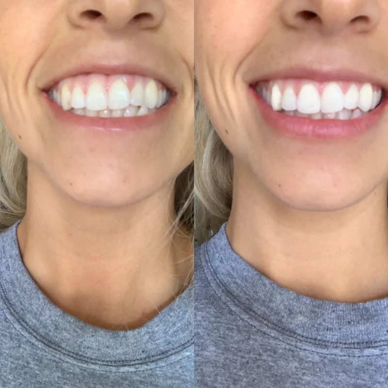 Set NanoSmile