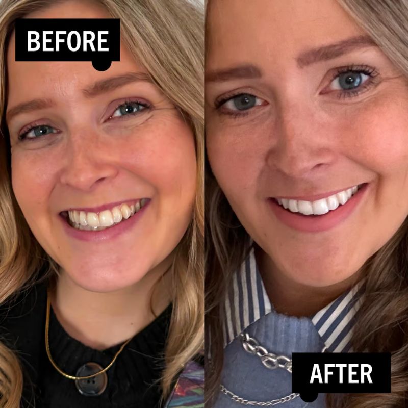 Set NanoSmile